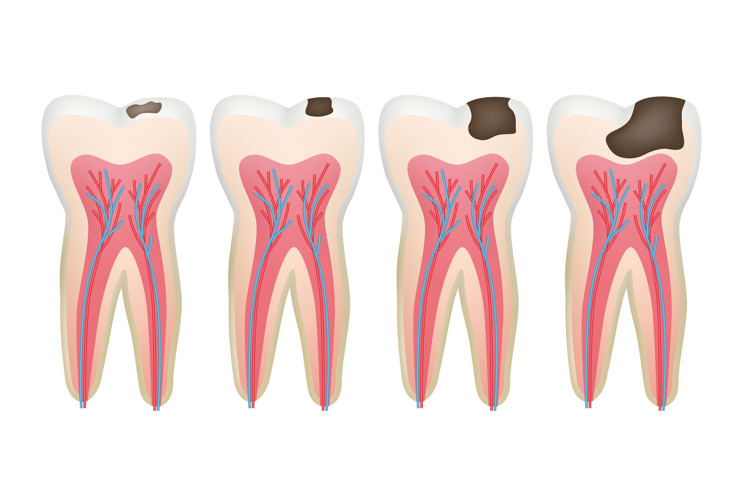 Las fases de la caries Avandental